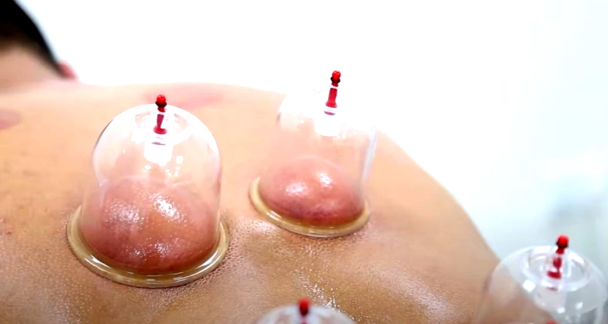 الحجامة: التقنية التقليدية التي تواصل إبهار العلماء بقدرتها العلاجية 