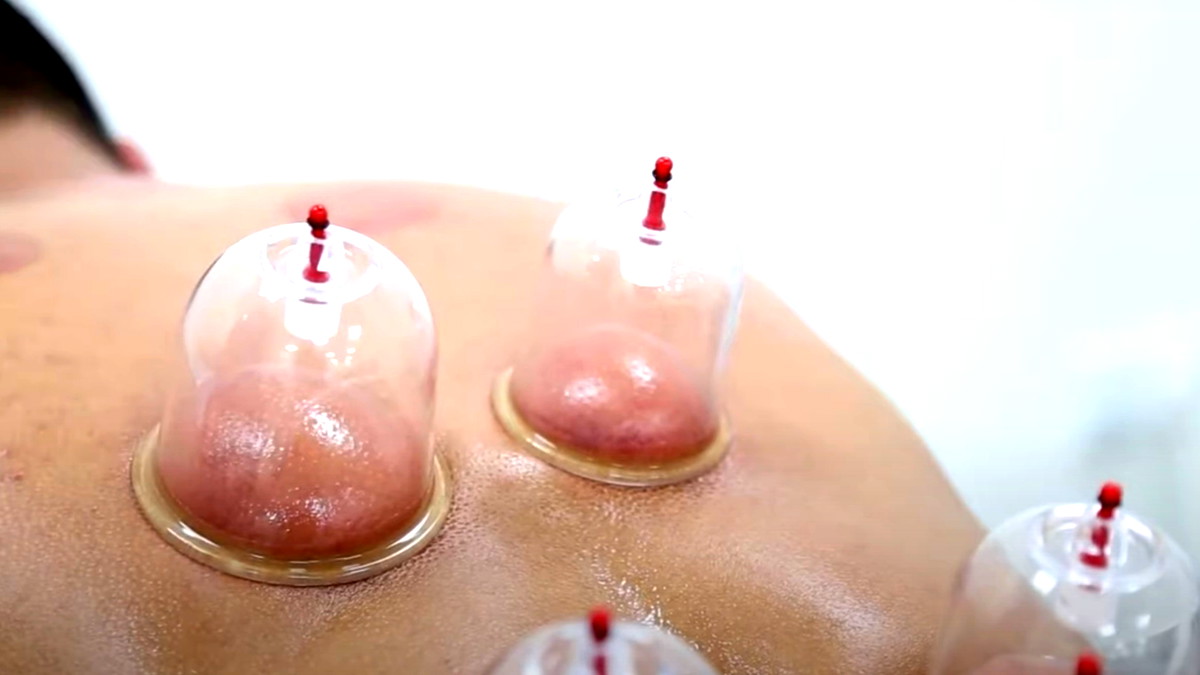 الحجامة: التقنية التقليدية التي تواصل إبهار العلماء بقدرتها العلاجية