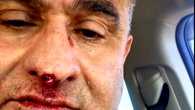 على خلفية عنصرية- الاعتداء على الطبيب محمّد مصالحة من كفرقرع من قبل مستوطن متطرّف 