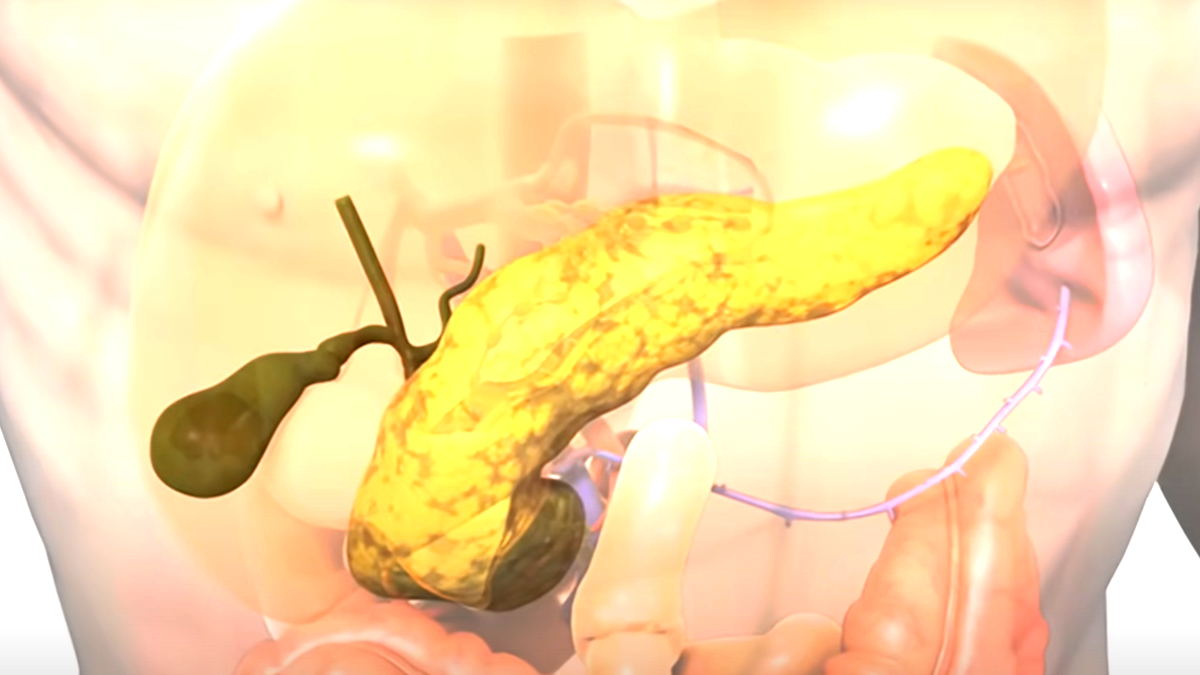 باحثون يطورون علاجًا مبتكرًا لسرطان البنكرياس