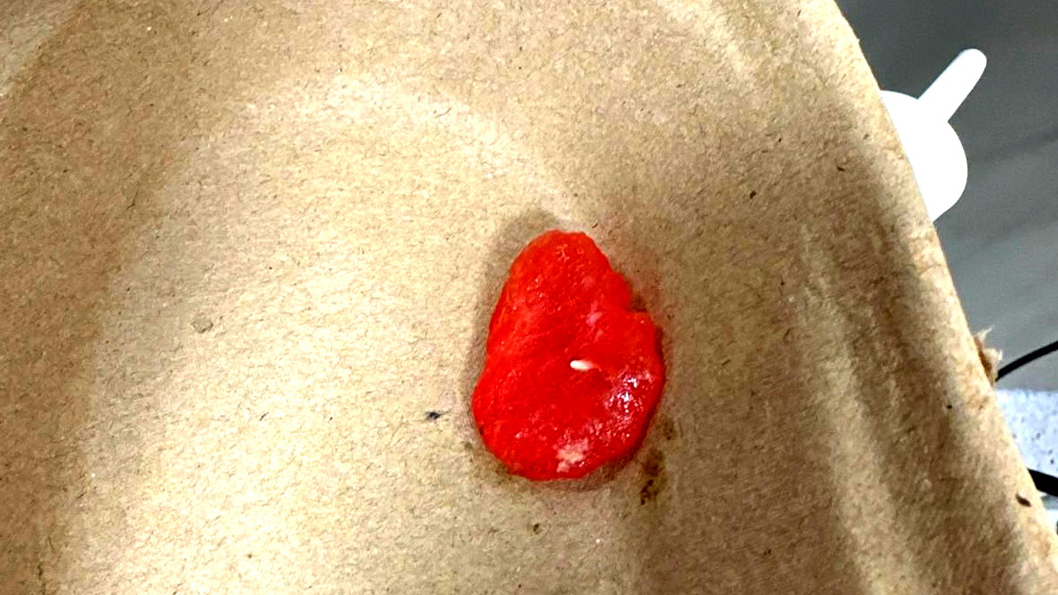 المركز الطبي زيڤ في صفد ينقذ حياة شخص اختنق بقطعة بطيخ في حالة نادرة الحدوث