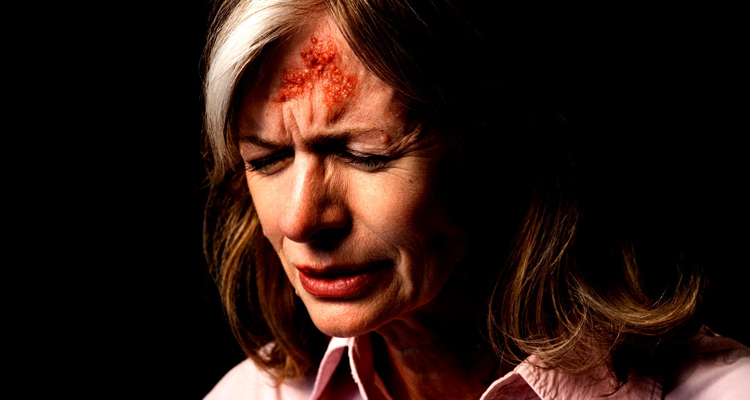 الحزام الناري (القوباء المنطقية)  ما هو هذا الكابوس؟ (ع.ع)