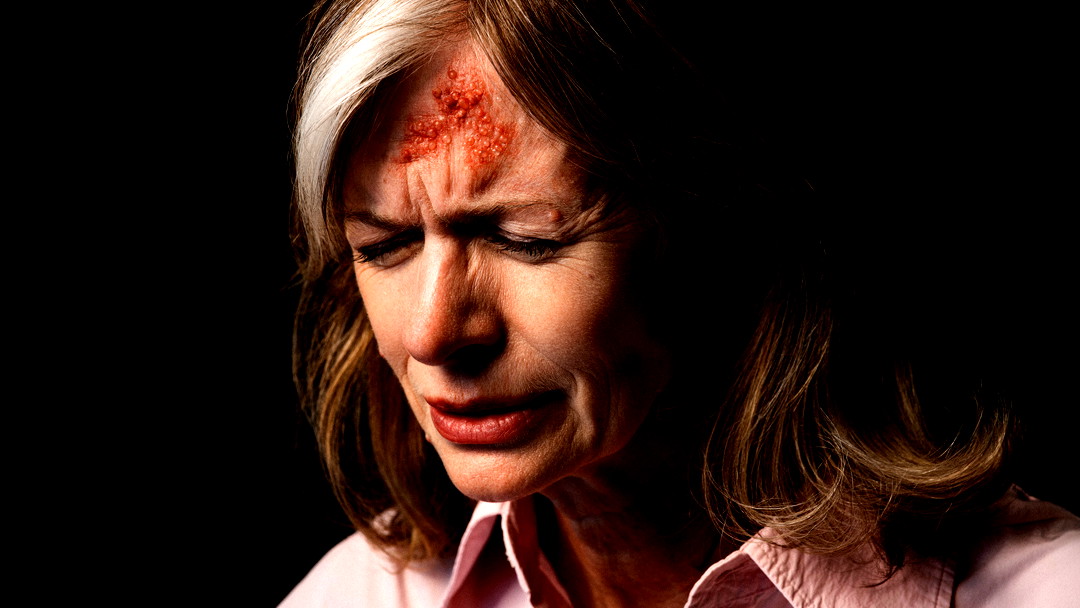 الحزام الناري (القوباء المنطقية)  ما هو هذا الكابوس؟