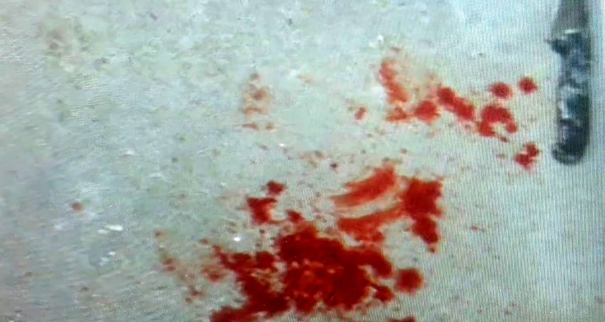 خلاف رومانسي ينتهي بالطعن: اعتقال شابة اعتدت على شريكها في حيفا