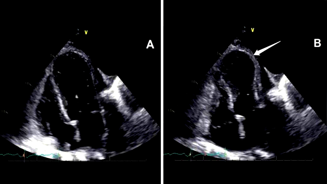 القلب يتأثر بالمشاعر: كيف يمكن للحب والحزن أن يؤثّرا فعليًا على صحة القلب؟