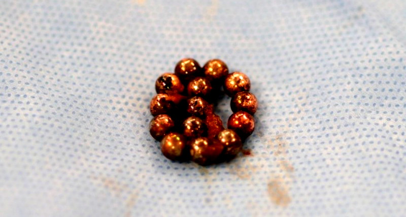 مثل صاروخ برأس منشطر: عملية جراحية طارئة لطفل في مستشفى رمبام إثر ابتلاعه سلسلة مغناطيسية