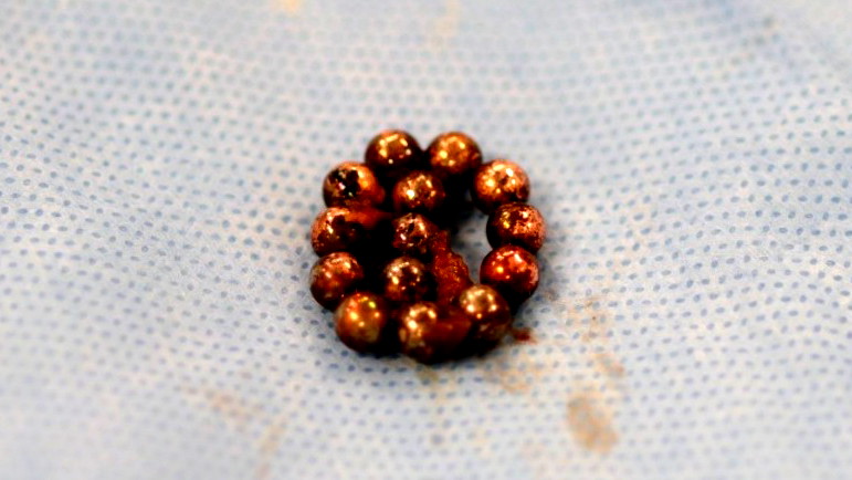 مثل صاروخ برأس منشطر: عملية جراحية طارئة لطفل في مستشفى رمبام إثر ابتلاعه سلسلة مغناطيسية